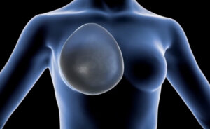 Something about Breast Enlargement Surgery