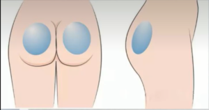 Buttock Augmentation Surgery – Our Lash