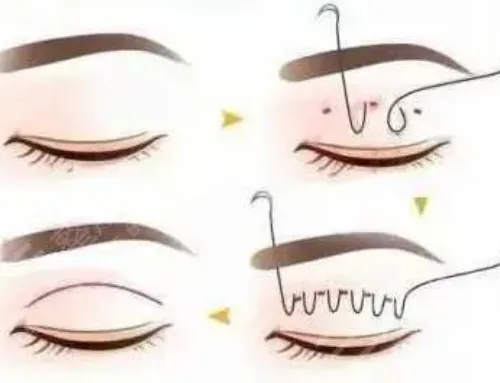 Double Eyelid Tape or Cosmetic Double Eyelid Surgery: Which Is Better?